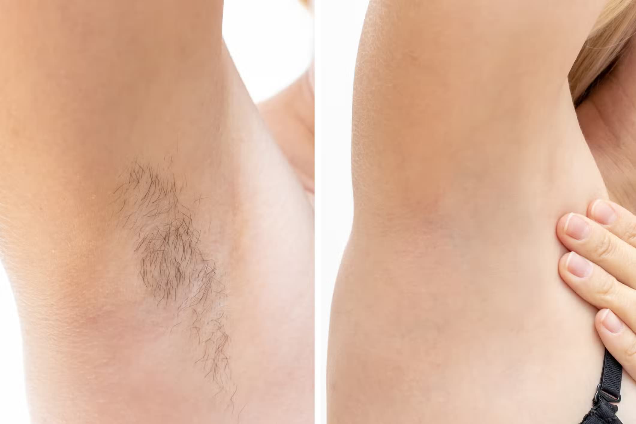 laser hair removal